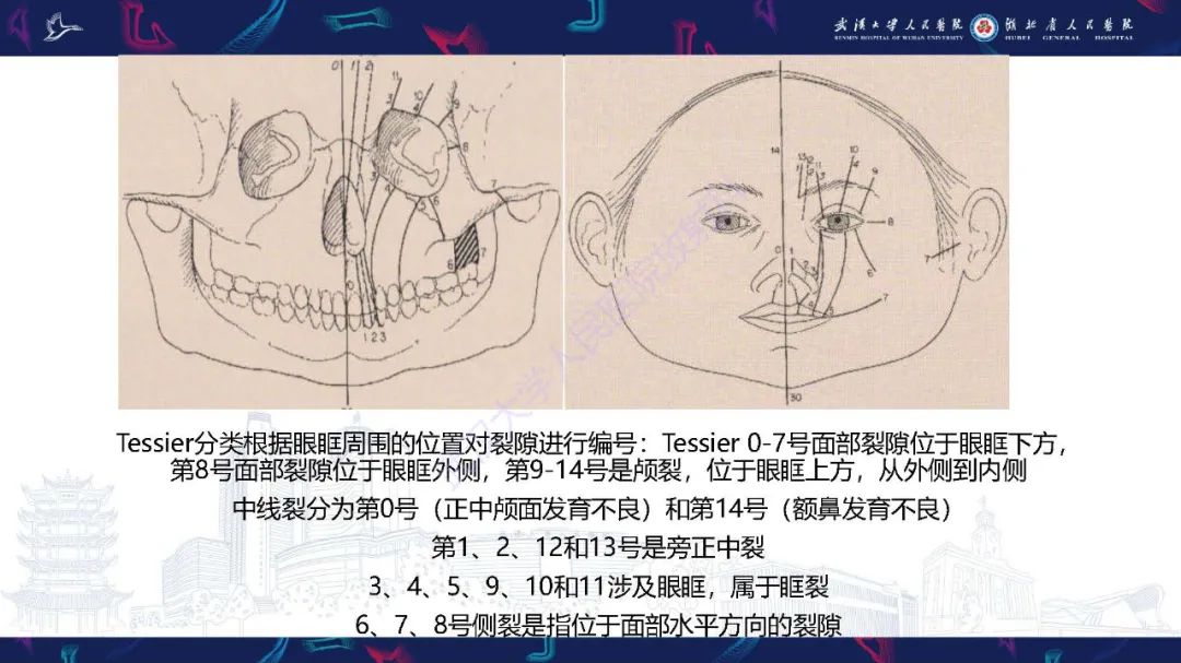 影像PPT - 【PPT】胎儿面部畸形MR诊断-27