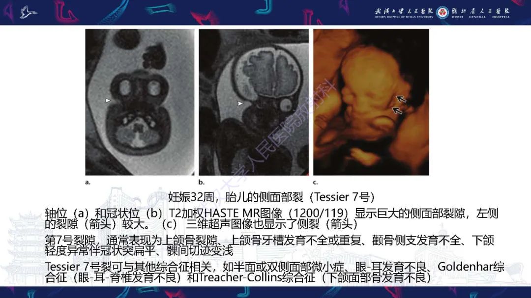 影像PPT - 【PPT】胎儿面部畸形MR诊断-28
