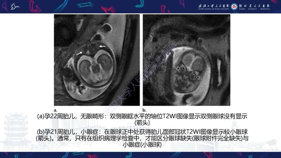 影像PPT - 【PPT】胎儿面部畸形MR诊断-31