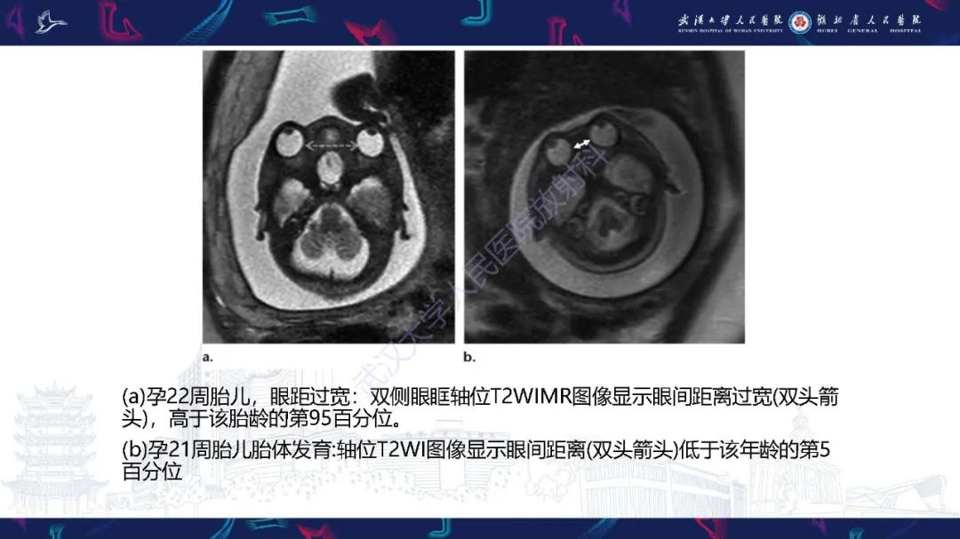 影像PPT - 【PPT】胎儿面部畸形MR诊断-33