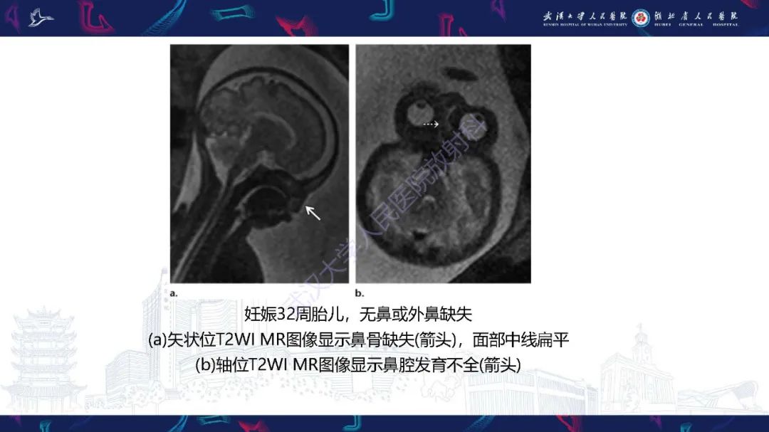 影像PPT - 【PPT】胎儿面部畸形MR诊断-36