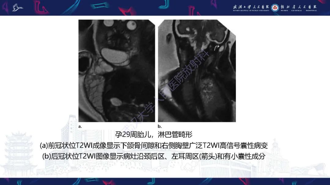 影像PPT - 【PPT】胎儿面部畸形MR诊断-39