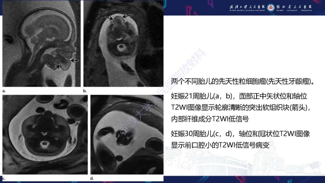 影像PPT - 【PPT】胎儿面部畸形MR诊断-43
