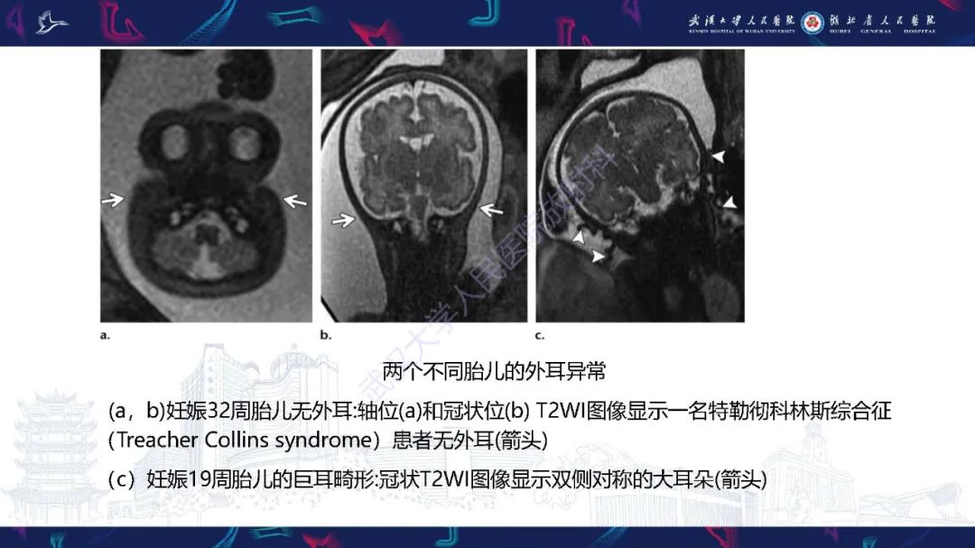 影像PPT - 【PPT】胎儿面部畸形MR诊断-47