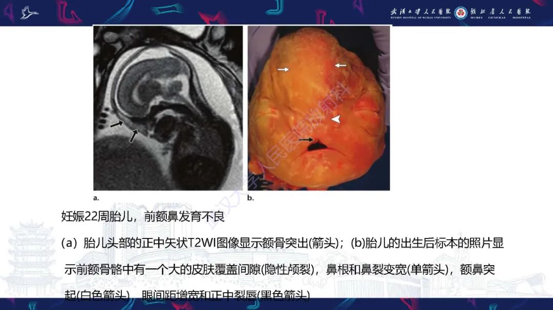 影像PPT - 【PPT】胎儿面部畸形MR诊断-49