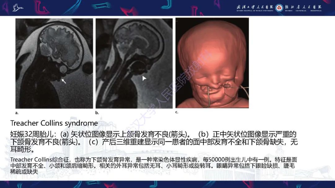 影像PPT - 【PPT】胎儿面部畸形MR诊断-52