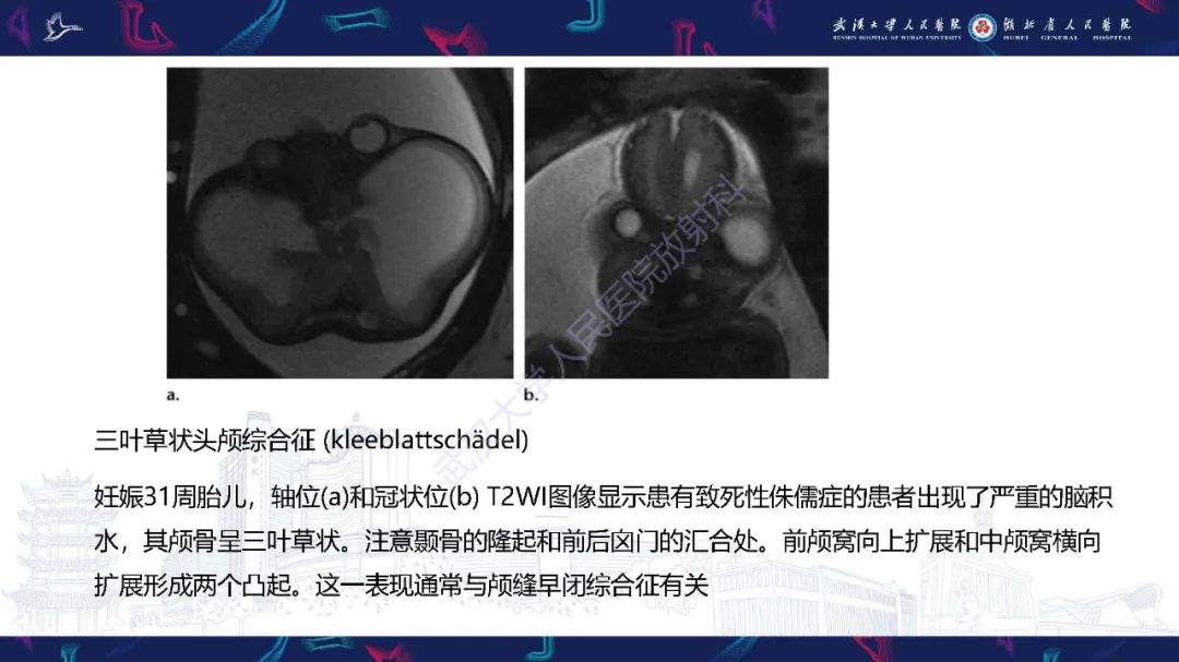 影像PPT - 【PPT】胎儿面部畸形MR诊断-54