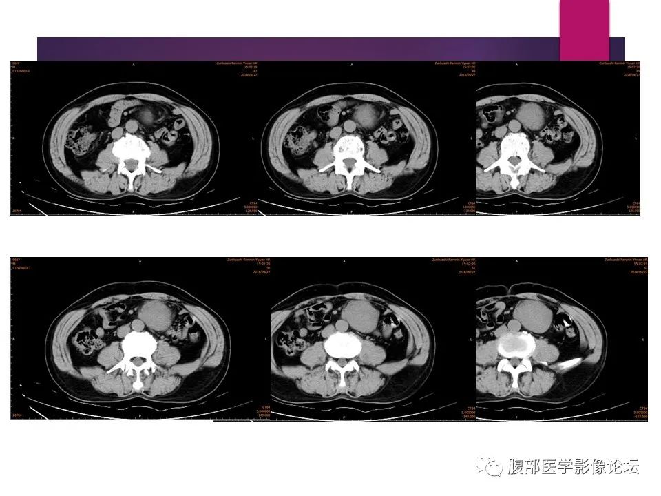 影像PPT - 【病例】肠系膜纤维瘤病1例CT影像-3