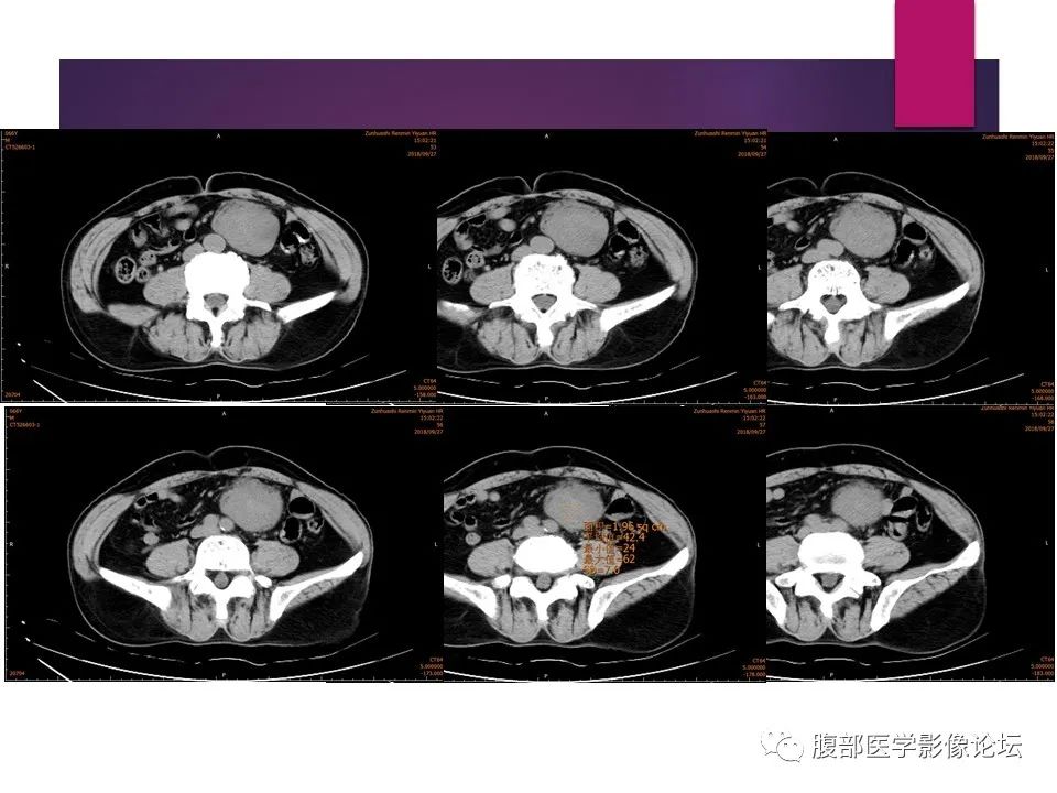 影像PPT - 【病例】肠系膜纤维瘤病1例CT影像-4