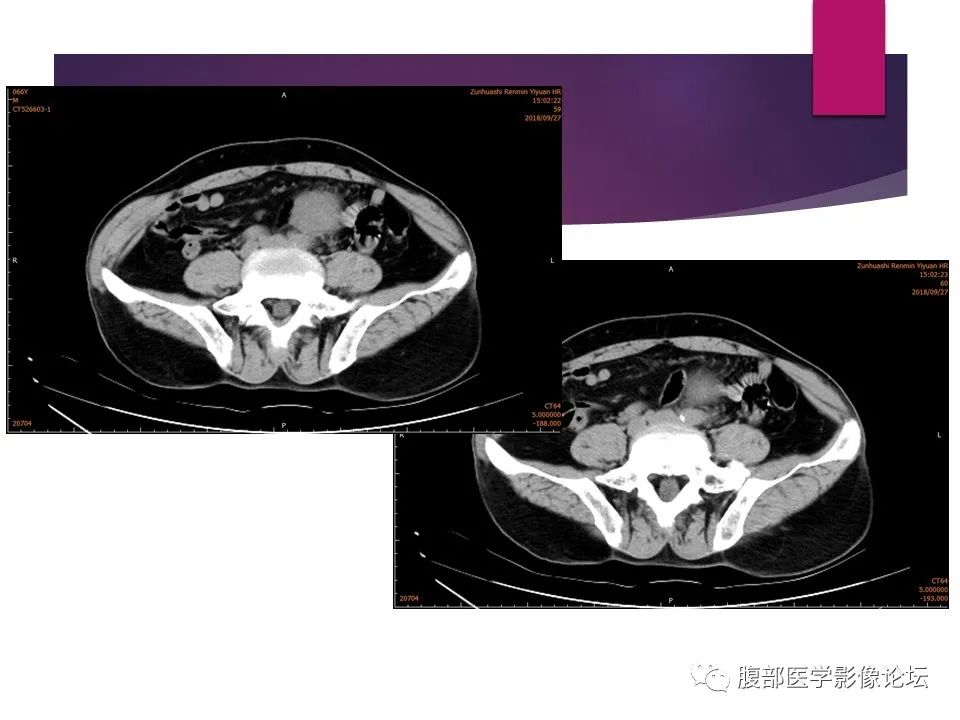 影像PPT - 【病例】肠系膜纤维瘤病1例CT影像-5