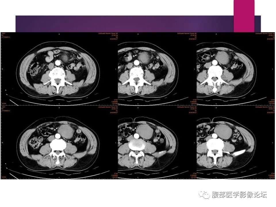 影像PPT - 【病例】肠系膜纤维瘤病1例CT影像-7