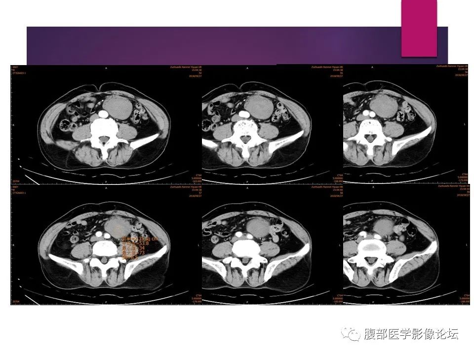 影像PPT - 【病例】肠系膜纤维瘤病1例CT影像-8