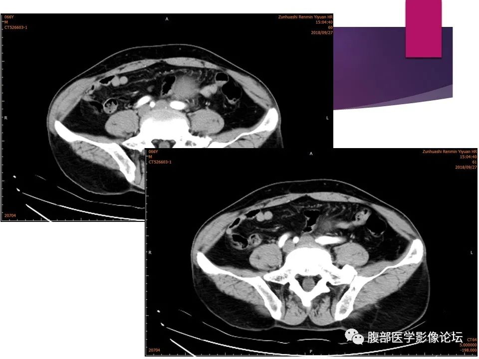 影像PPT - 【病例】肠系膜纤维瘤病1例CT影像-9
