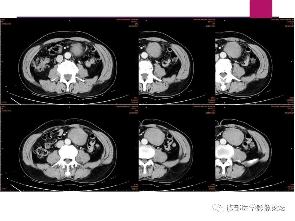 影像PPT - 【病例】肠系膜纤维瘤病1例CT影像-11