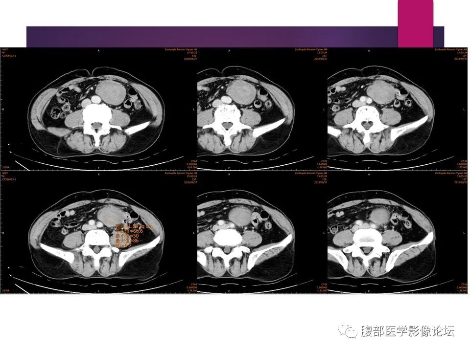 影像PPT - 【病例】肠系膜纤维瘤病1例CT影像-12