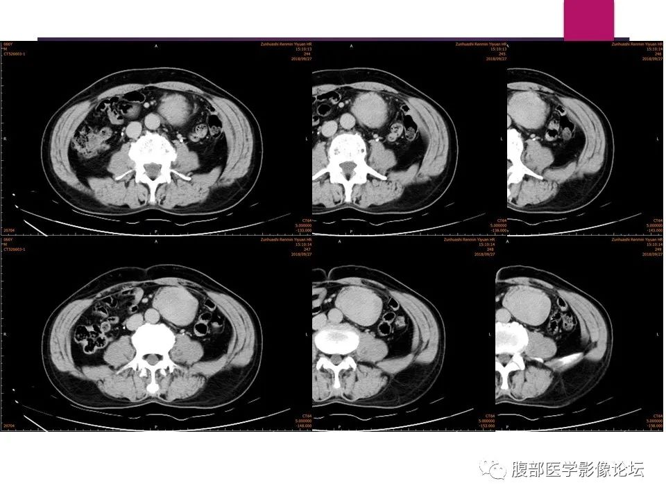 影像PPT - 【病例】肠系膜纤维瘤病1例CT影像-14