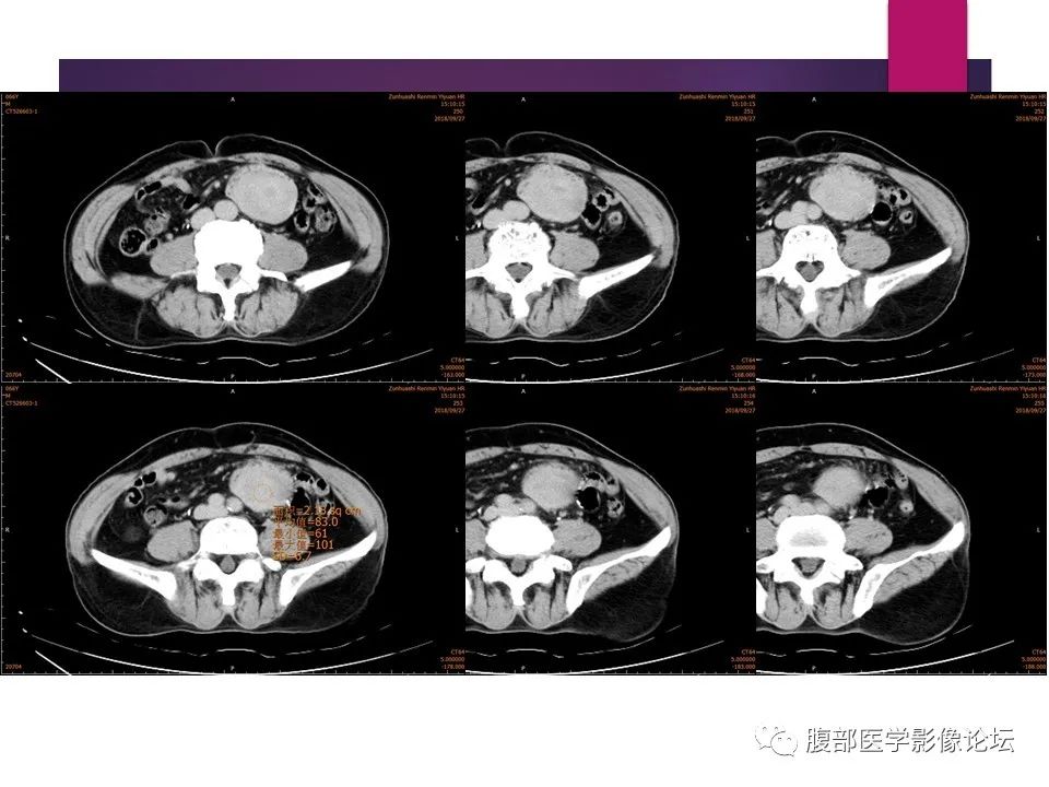 影像PPT - 【病例】肠系膜纤维瘤病1例CT影像-15