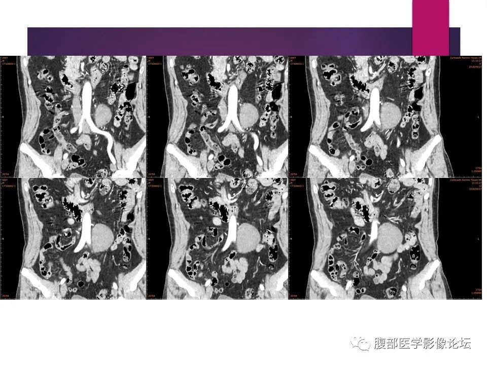 影像PPT - 【病例】肠系膜纤维瘤病1例CT影像-16
