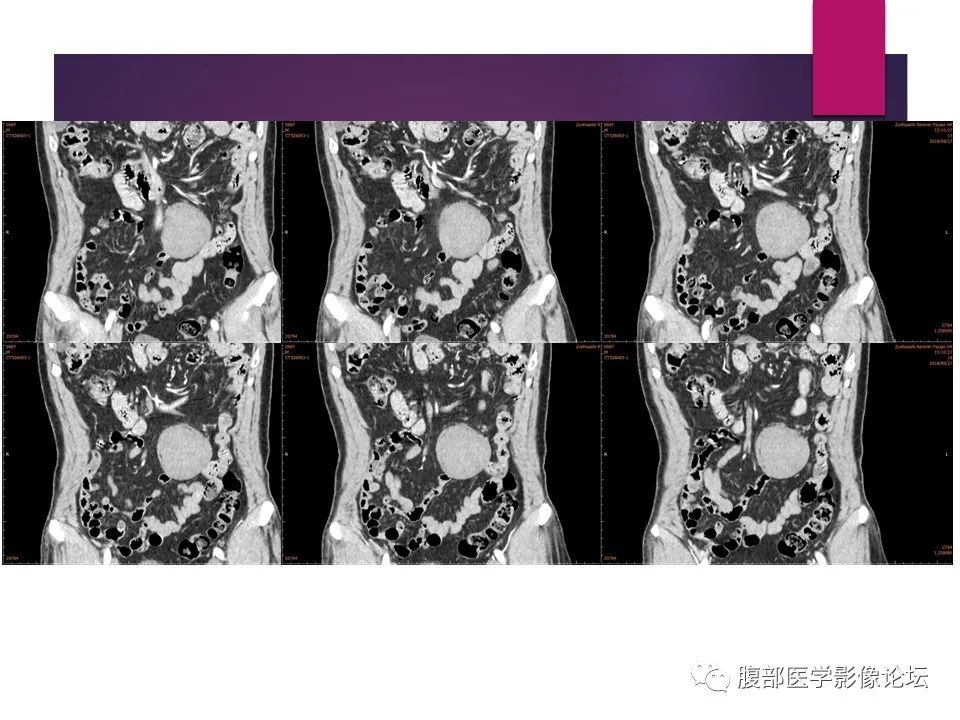 影像PPT - 【病例】肠系膜纤维瘤病1例CT影像-17