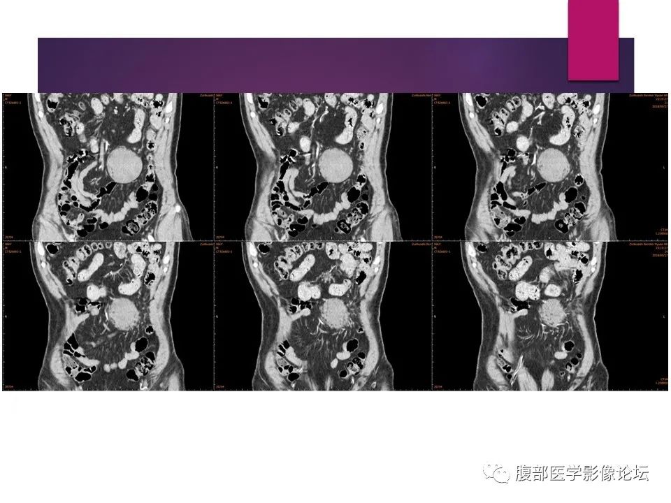 影像PPT - 【病例】肠系膜纤维瘤病1例CT影像-18