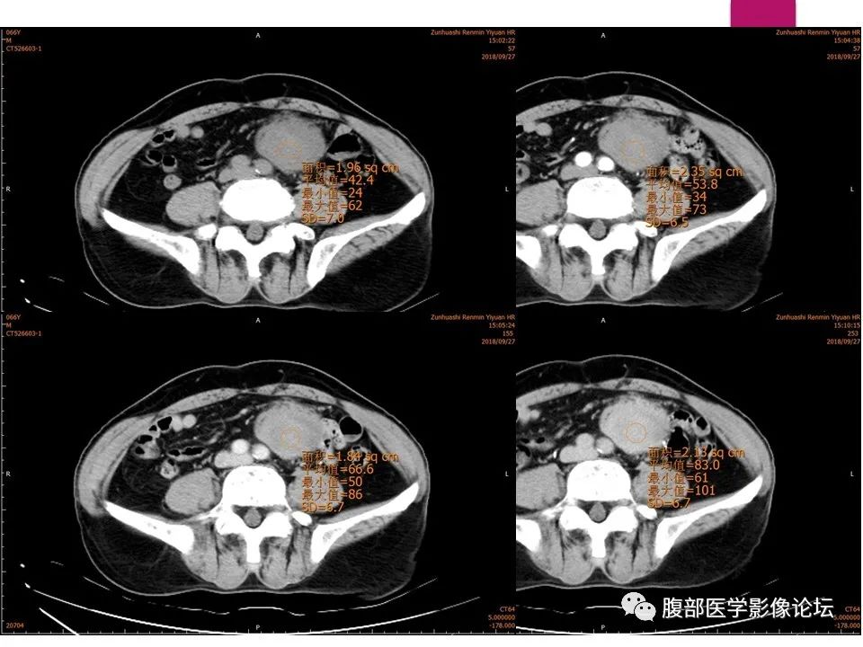 影像PPT - 【病例】肠系膜纤维瘤病1例CT影像-19