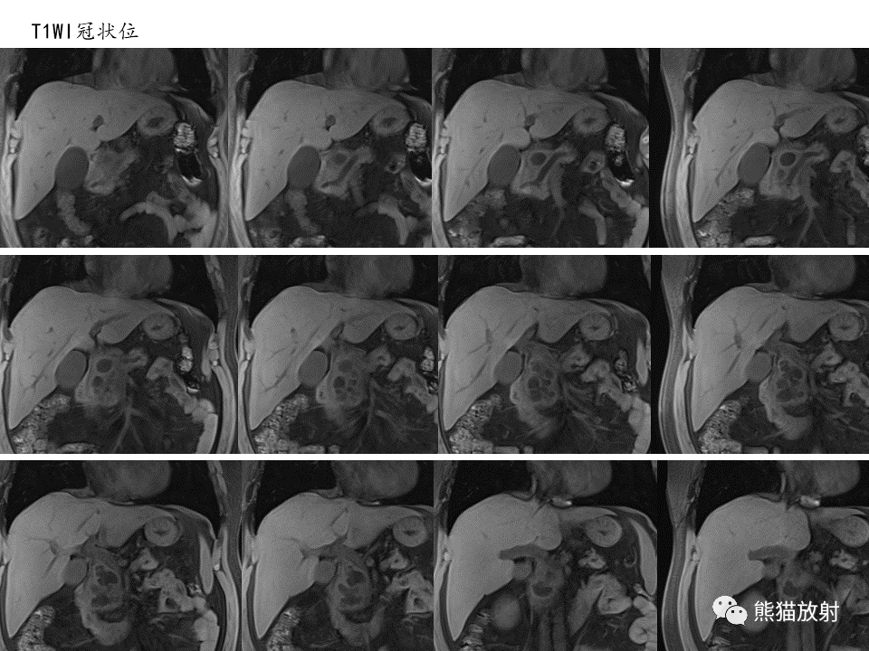 影像PPT - 【病例】慢性胰腺炎VS胰腺导管内乳头状黏液性肿瘤-7