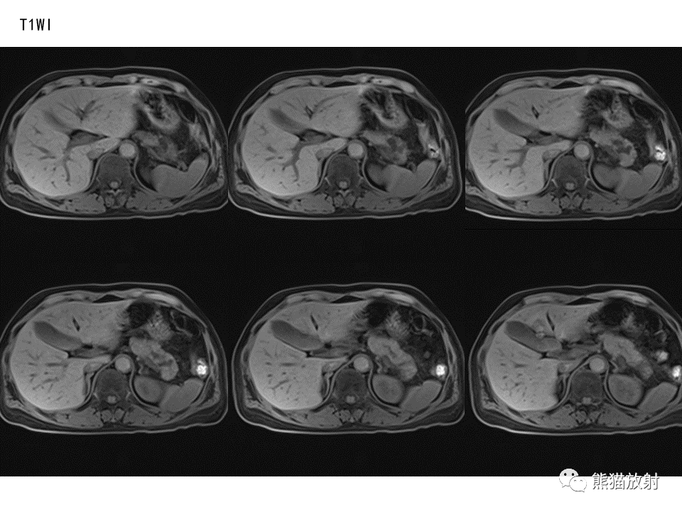 影像PPT - 【病例】慢性胰腺炎VS胰腺导管内乳头状黏液性肿瘤-17