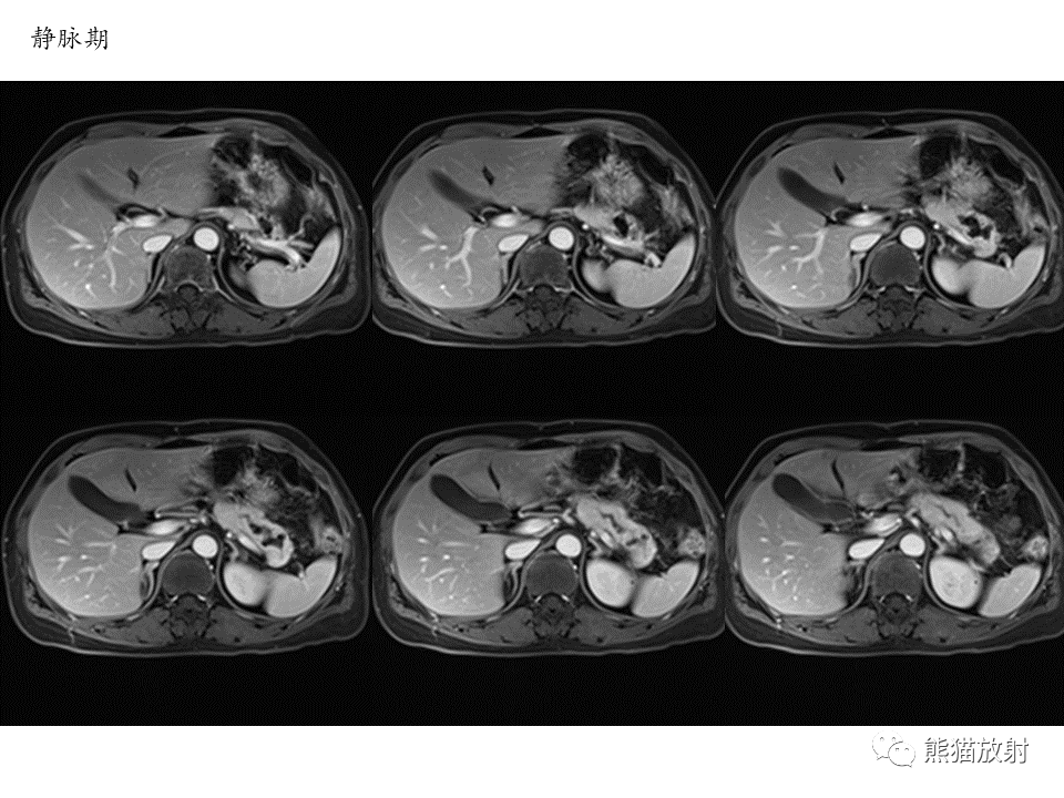 影像PPT - 【病例】慢性胰腺炎VS胰腺导管内乳头状黏液性肿瘤-19