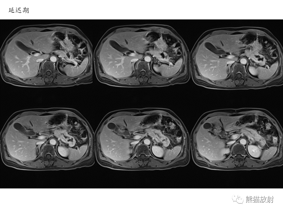影像PPT - 【病例】慢性胰腺炎VS胰腺导管内乳头状黏液性肿瘤-21