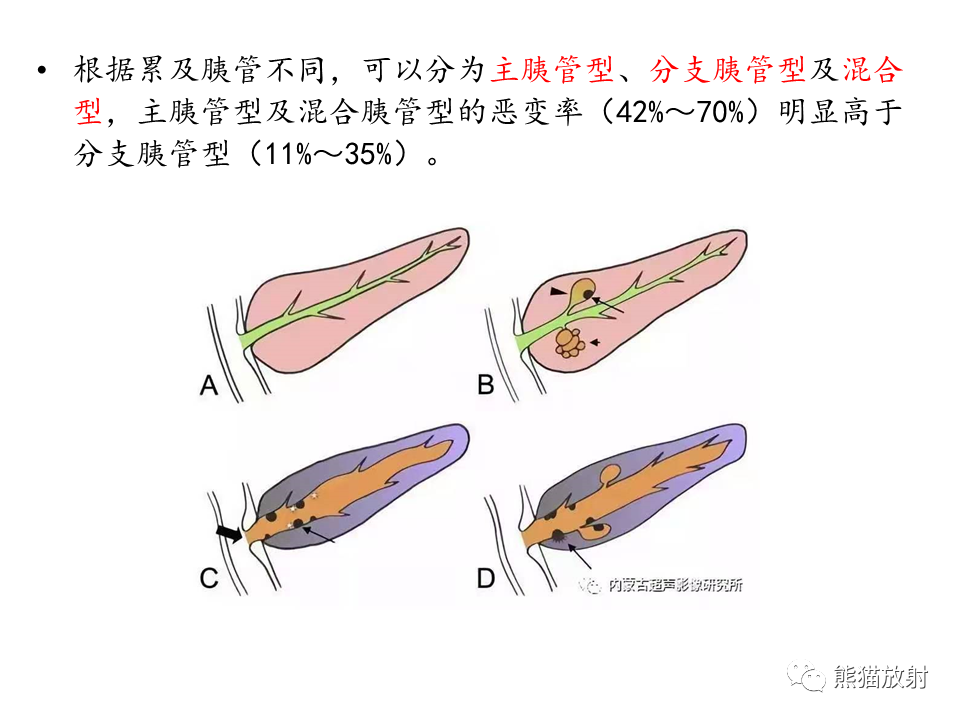 影像PPT - 【病例】慢性胰腺炎VS胰腺导管内乳头状黏液性肿瘤-30