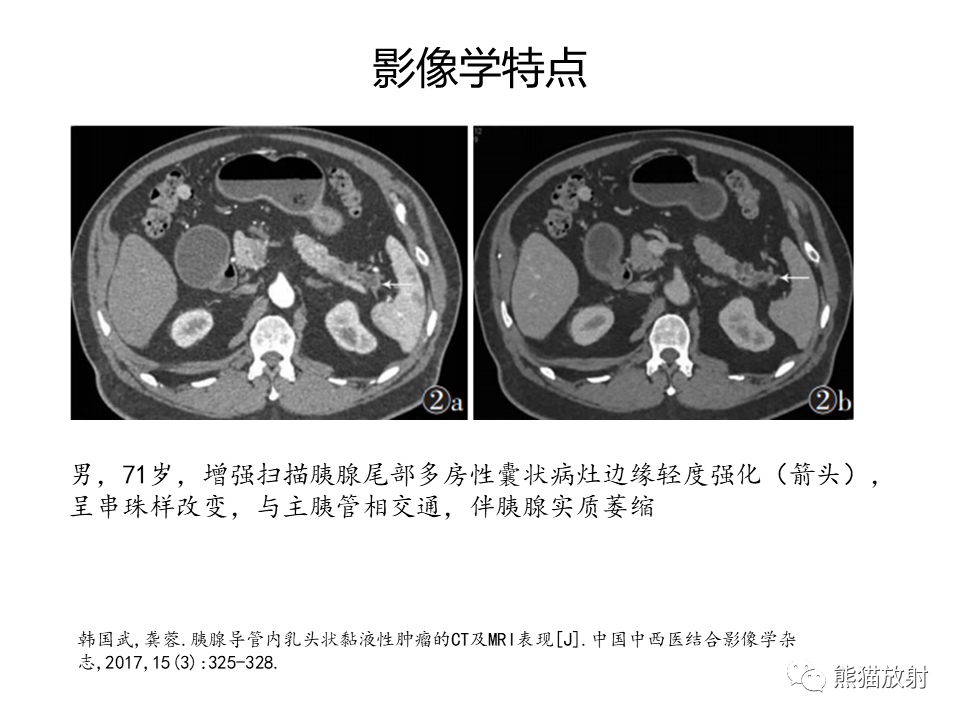 影像PPT - 【病例】慢性胰腺炎VS胰腺导管内乳头状黏液性肿瘤-34