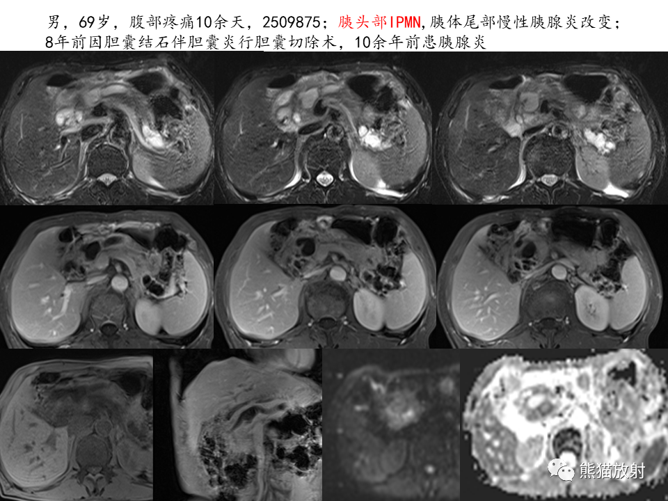 影像PPT - 【病例】慢性胰腺炎VS胰腺导管内乳头状黏液性肿瘤-36