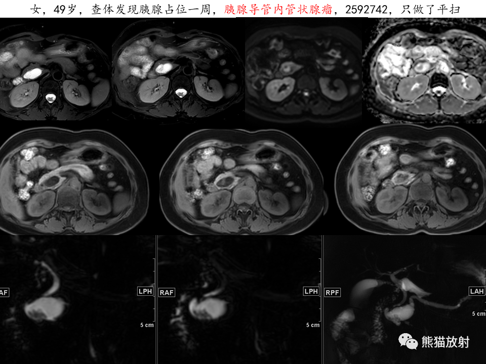 影像PPT - 【病例】慢性胰腺炎VS胰腺导管内乳头状黏液性肿瘤-37