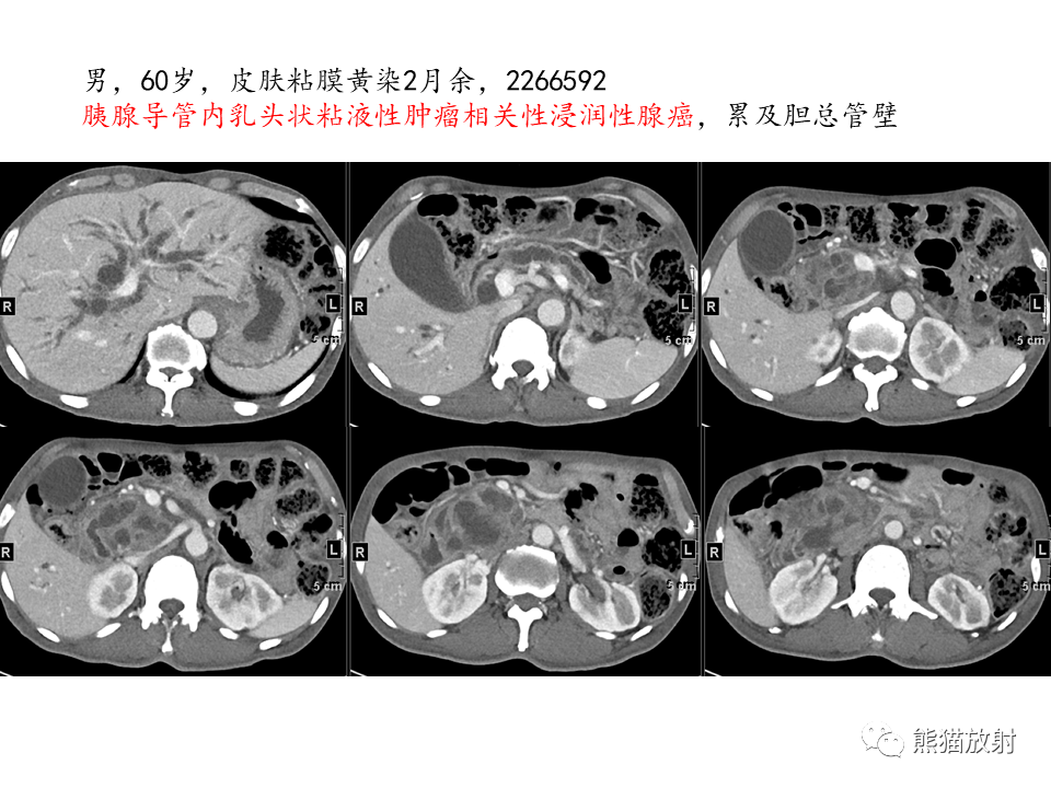 影像PPT - 【病例】慢性胰腺炎VS胰腺导管内乳头状黏液性肿瘤-38