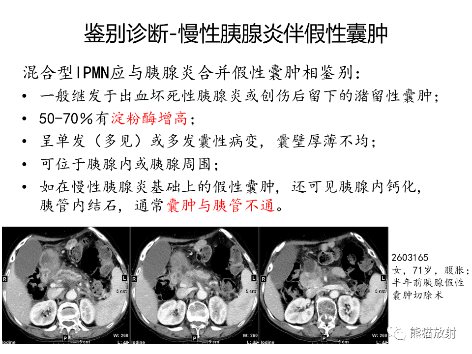 影像PPT - 【病例】慢性胰腺炎VS胰腺导管内乳头状黏液性肿瘤-40