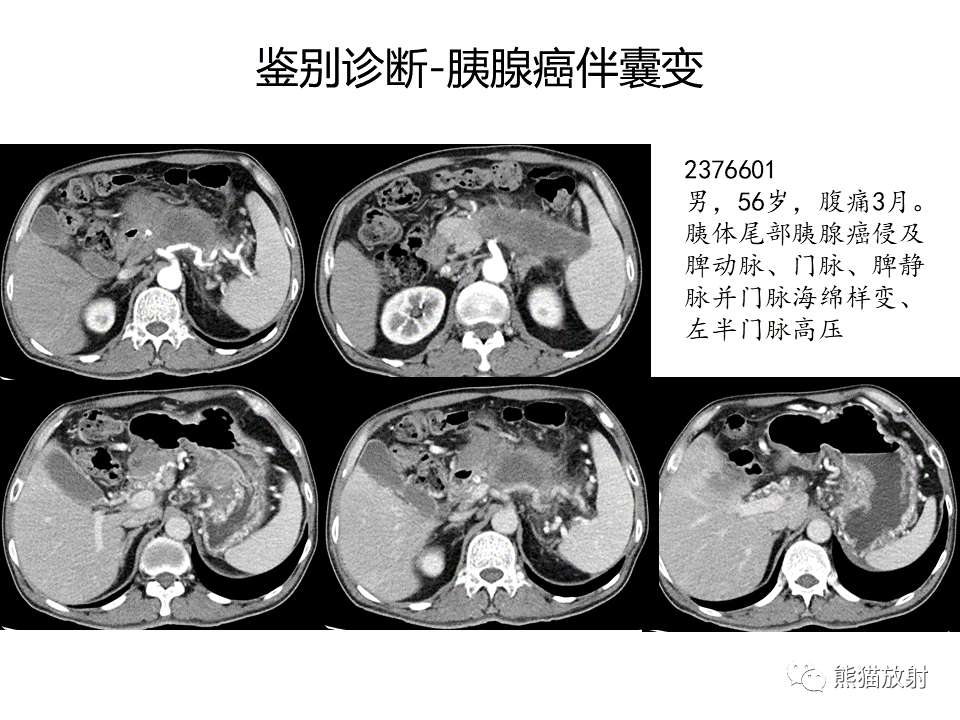 影像PPT - 【病例】慢性胰腺炎VS胰腺导管内乳头状黏液性肿瘤-42