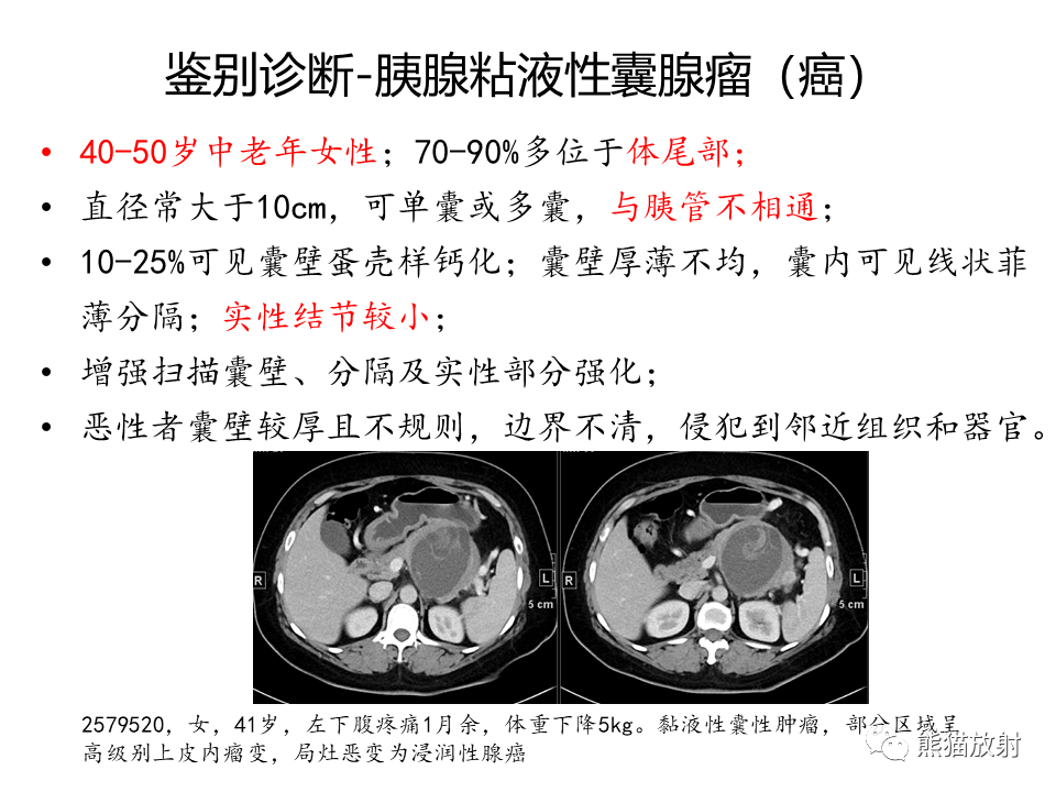 影像PPT - 【病例】慢性胰腺炎VS胰腺导管内乳头状黏液性肿瘤-43