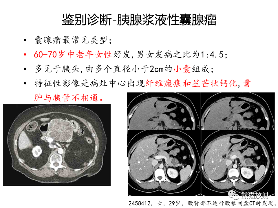 影像PPT - 【病例】慢性胰腺炎VS胰腺导管内乳头状黏液性肿瘤-44