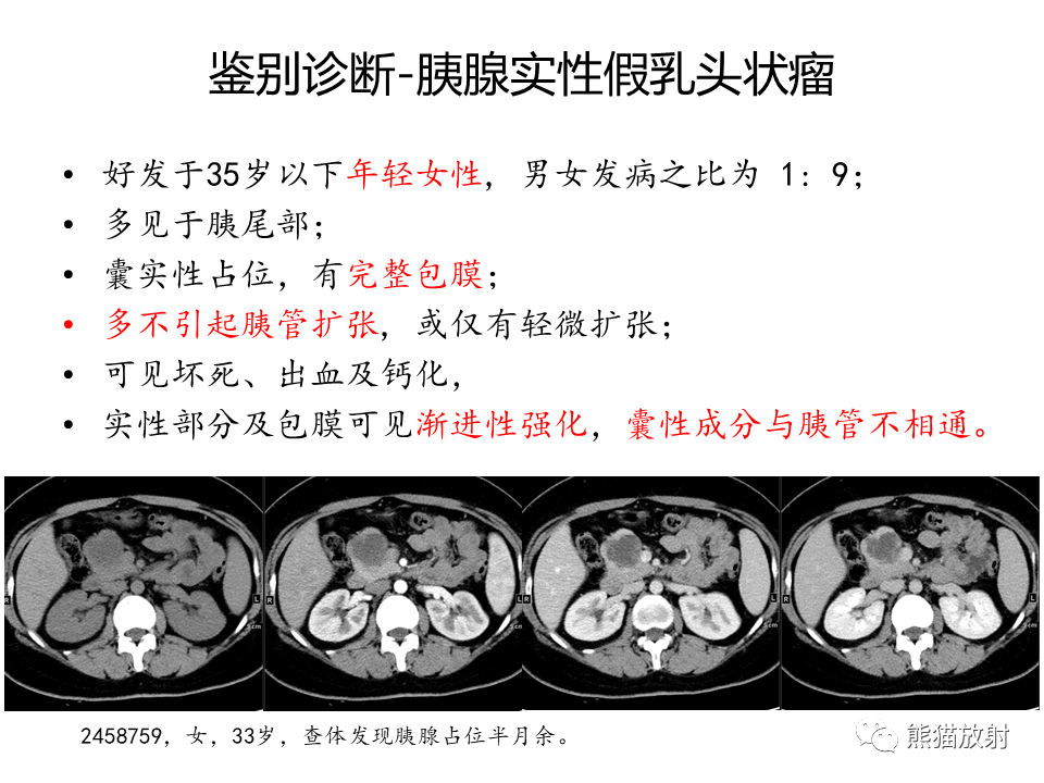 影像PPT - 【病例】慢性胰腺炎VS胰腺导管内乳头状黏液性肿瘤-45