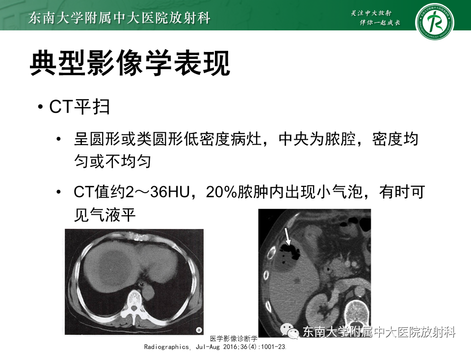 影像PPT - 【病例】细菌性肝脓肿1例CT影像-8