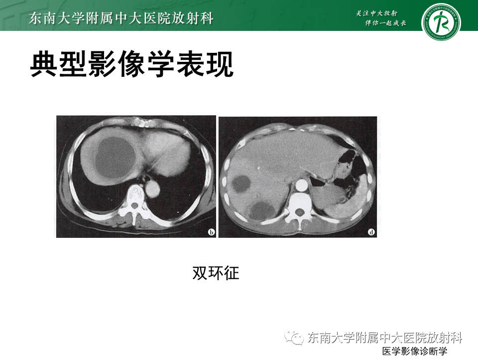 影像PPT - 【病例】细菌性肝脓肿1例CT影像-10