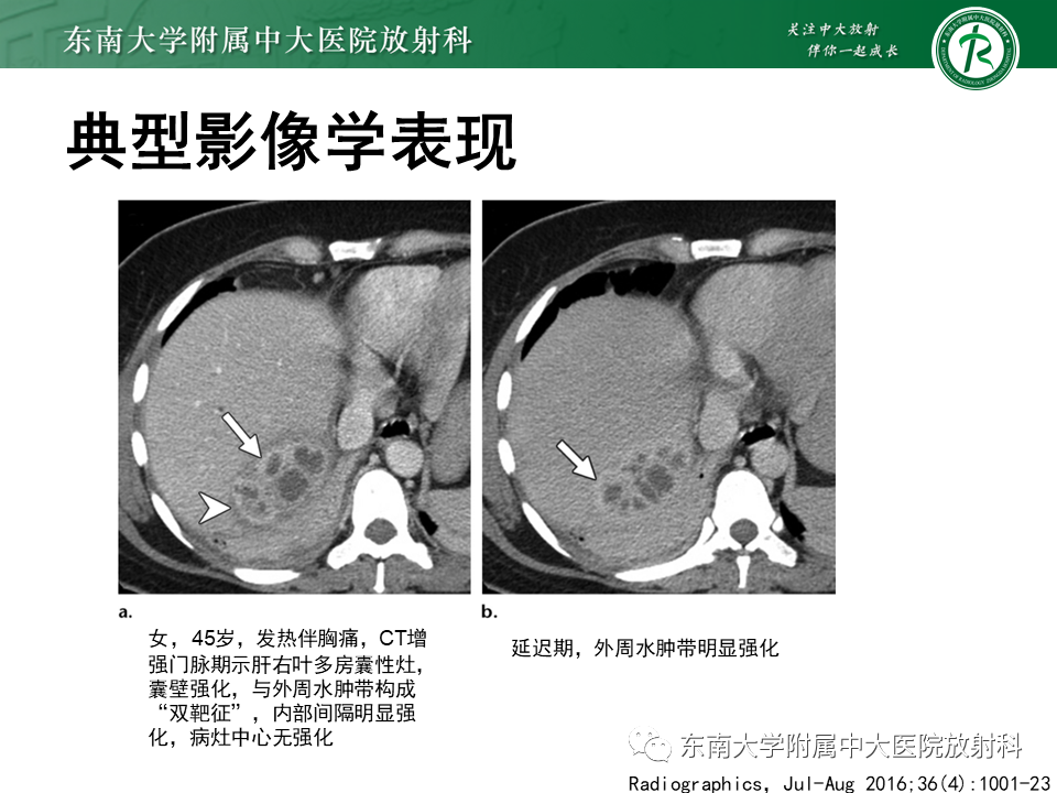 影像PPT - 【病例】细菌性肝脓肿1例CT影像-12