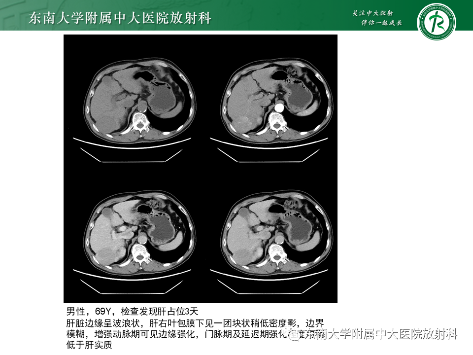影像PPT - 【病例】细菌性肝脓肿1例CT影像-15