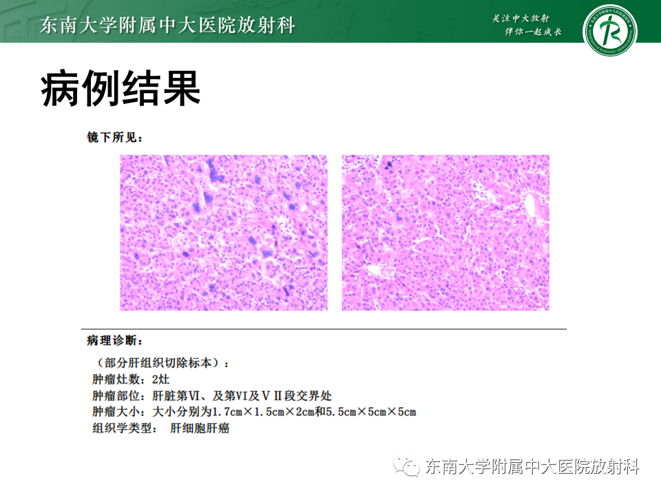 影像PPT - 【病例】细菌性肝脓肿1例CT影像-16