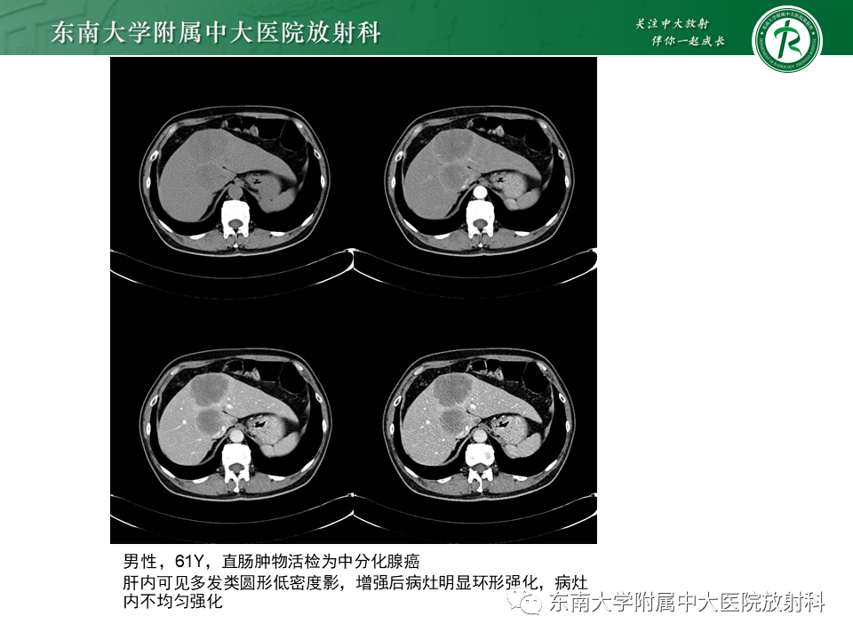 影像PPT - 【病例】细菌性肝脓肿1例CT影像-18