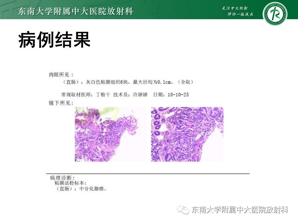 影像PPT - 【病例】细菌性肝脓肿1例CT影像-19