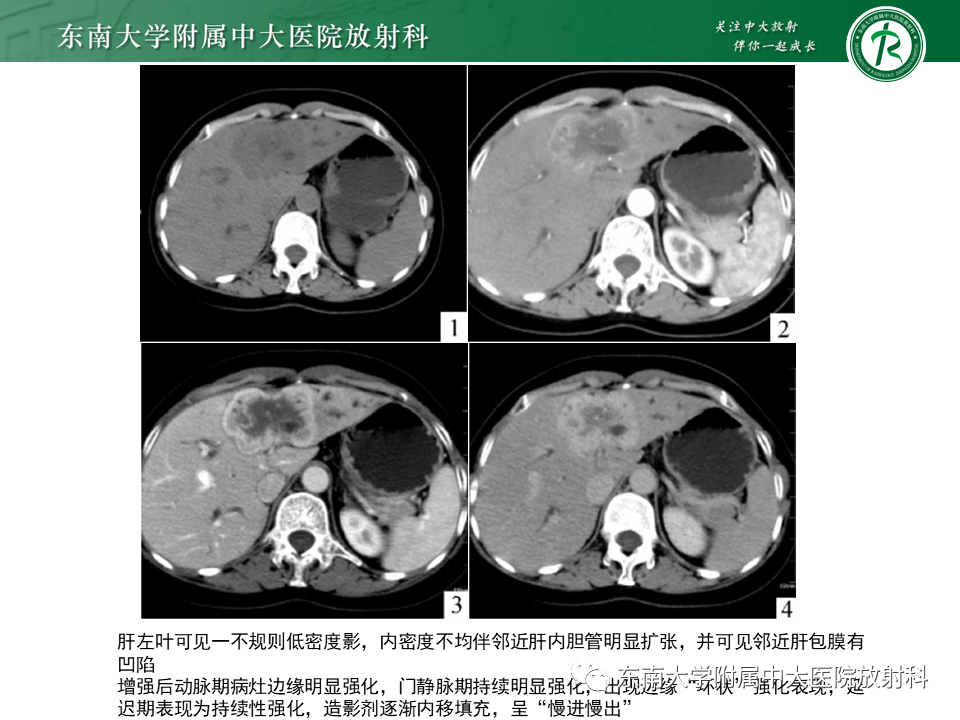 影像PPT - 【病例】细菌性肝脓肿1例CT影像-22