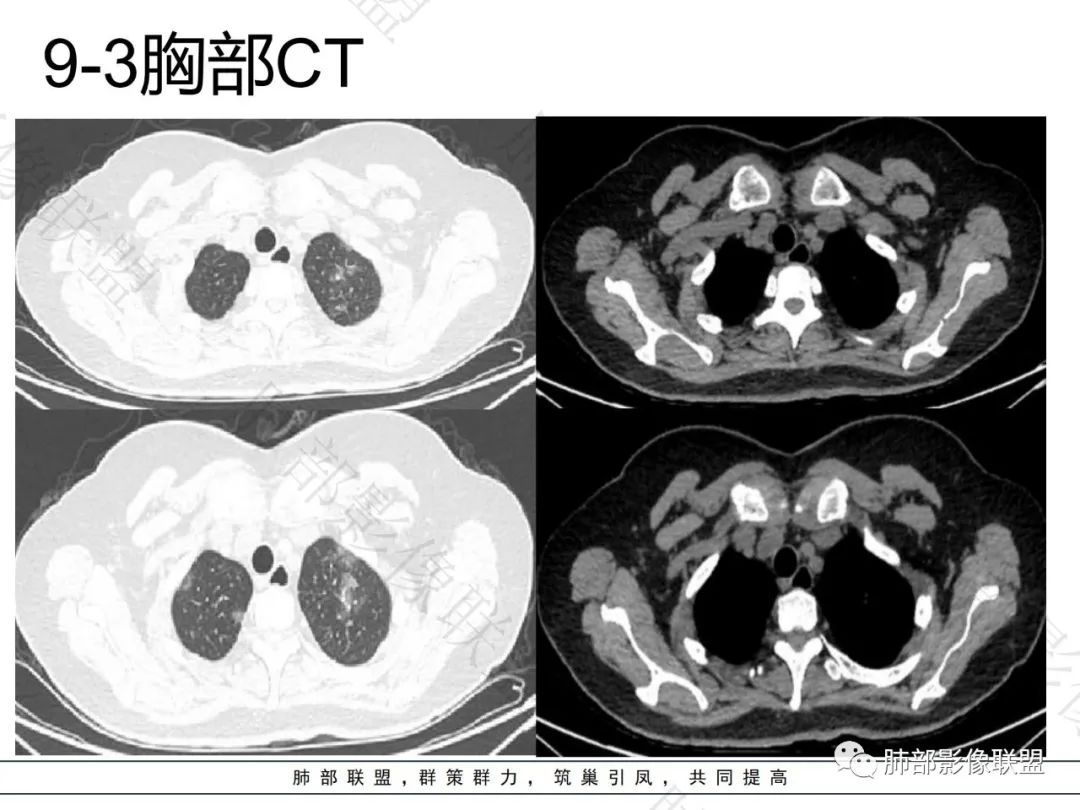 影像PPT - 【病例】淋巴瘤肺浸润1例CT影像讨论-4 影像PPT - 【病例】淋巴瘤肺浸润1例CT影像讨论-4