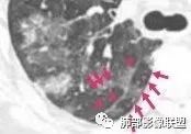 影像PPT - 【病例】淋巴瘤肺浸润1例CT影像讨论-13 影像PPT - 【病例】淋巴瘤肺浸润1例CT影像讨论-13