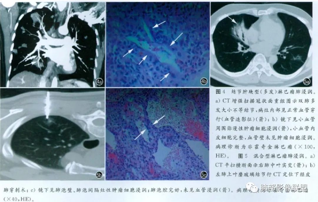 影像PPT - 【病例】淋巴瘤肺浸润1例CT影像讨论-25